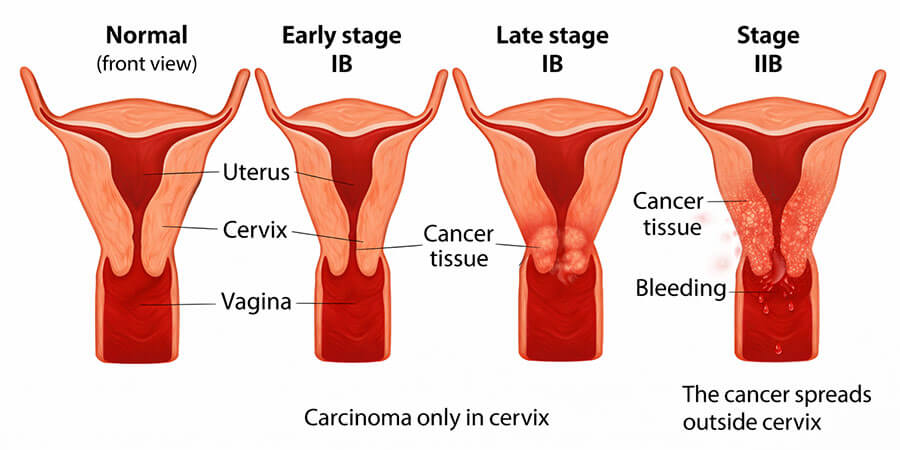 Diagnosis and Treatment of Gynecological Malignancies